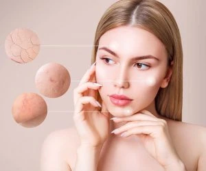 Informatie foto acne