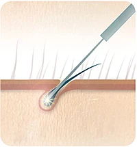 elektrisch ontharen lalique1