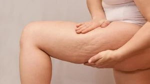 Cellulite